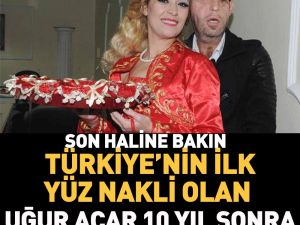 Türkiye’de ilk yüz nakli yapılan isimlerdi!