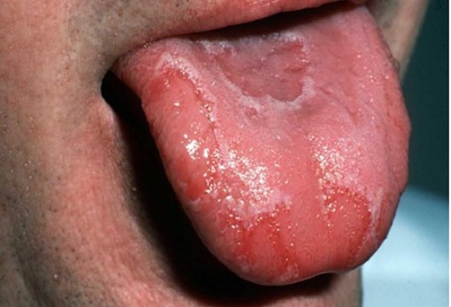 Dilinizin Hastalıkların Habercisi Olduğunu Biliyor Muydunuz? galerisi resim 6