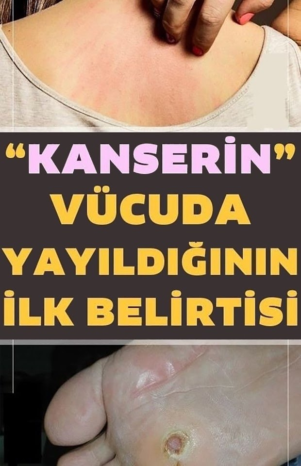Kanserin  1 belirtisi  daha ortaya çıktı. galerisi resim 1