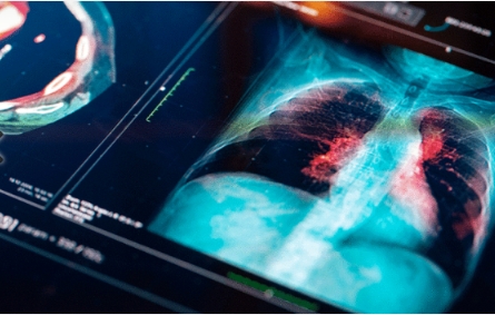 Parmak Testiyle Akciğer Kanseri Riskinizi Ölçebilirsiniz galerisi resim 2