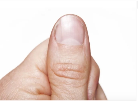 Parmak Testiyle Akciğer Kanseri Riskinizi Ölçebilirsiniz galerisi resim 4