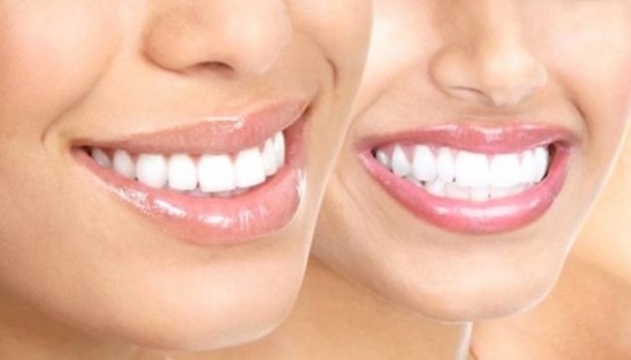 Dişlerinizi alüminyum folyoyla kaplayın ve bekleyin! galerisi resim 9