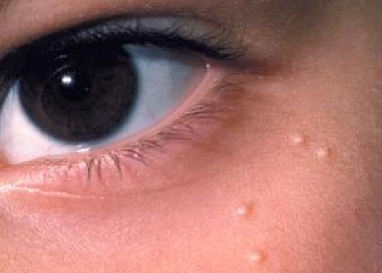 Göz Çevresindeki Yağ Bezeleri Nasıl Geçer galerisi resim 3