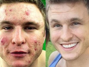 Sivilce Probleminden Böyle Kurtuldu