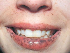 SİZDE DE BU BELİRTİLER VARSA EĞER….GÜN GEÇTİKÇE YAYILIYOR!