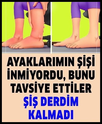 Ayaklarımın Şişi İnmiyordu, Bunu Tavsiye Ettiler galerisi resim 1