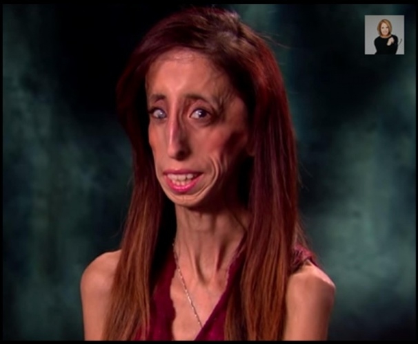 Ameliyat üstüne ameliyat oldu... şimdi tek hayali var aşık olmak . galerisi resim 2