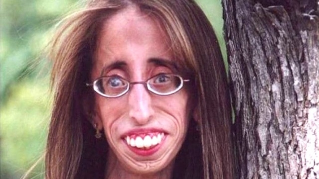 Ameliyat üstüne ameliyat oldu... şimdi tek hayali var aşık olmak . galerisi resim 3