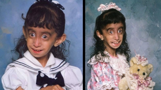 Ameliyat üstüne ameliyat oldu... şimdi tek hayali var aşık olmak . galerisi resim 6