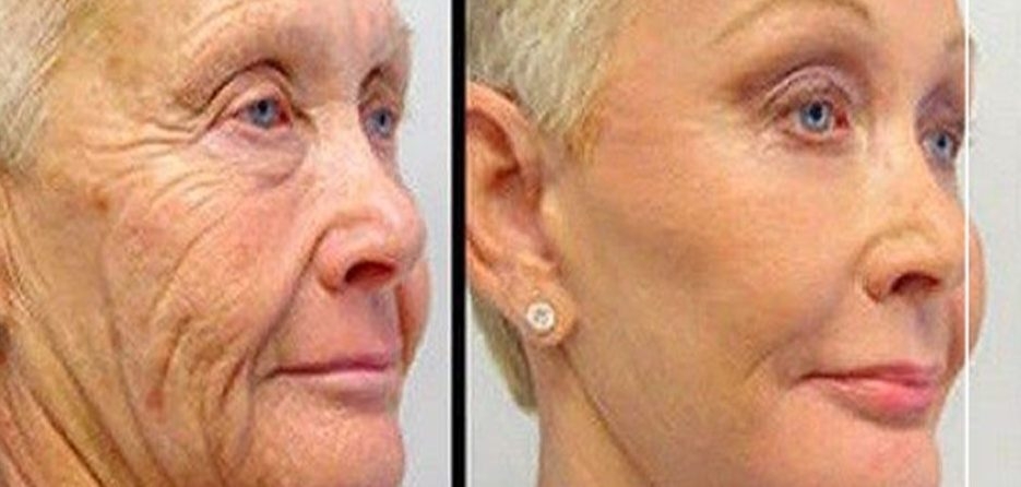 Her Sabah Yüzünüzü Bu 2 Malzemeli Karışımla Yıkayın galerisi resim 2