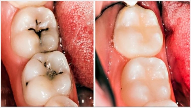 Nişanına tam bir gün kala... Çürük diş k'anser etti! galerisi resim 4