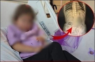 4 Yaşındaki Küçük Kızın bağırsağın dan çıkanlar şaşkına Çevirdi.. galerisi resim 2