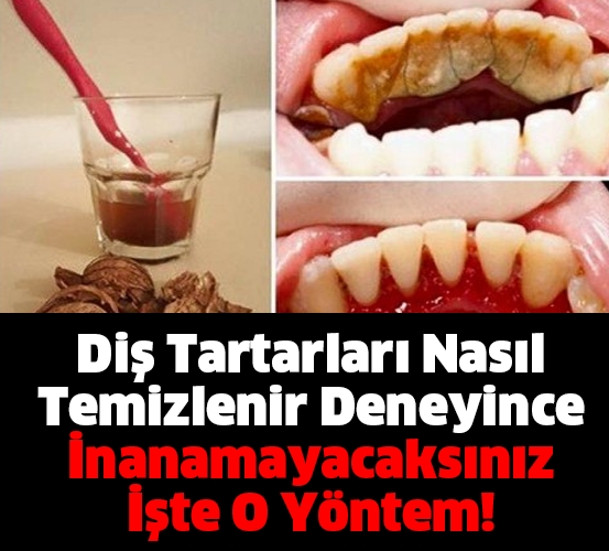 Diş Tartarlarını Tarihe Gömen Yöntem galerisi resim 1