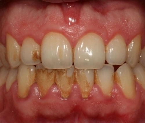 Diş Tartarlarını Tarihe Gömen Yöntem galerisi resim 5