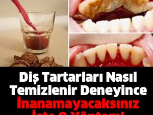 Diş Tartarlarını Tarihe Gömen Yöntem