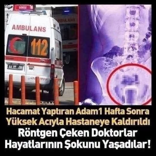 Şanlıurfa’da tedavi için hacamat yaptıran adam
