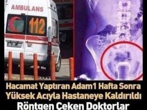 Şanlıurfa’da tedavi için hacamat yaptıran adam