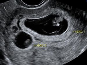 10 GÜN İÇİNDE İKİ KEZ HAMİLE KALDI