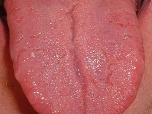 En ölümcül kanser türünün ilk belirtisi