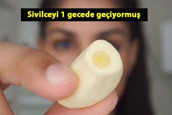 Sivilceyi 1 gecede geçiren yöntem galerisi resim 1