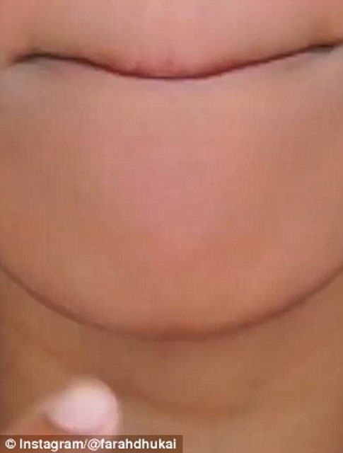 Sivilceyi 1 gecede geçiren yöntem galerisi resim 8