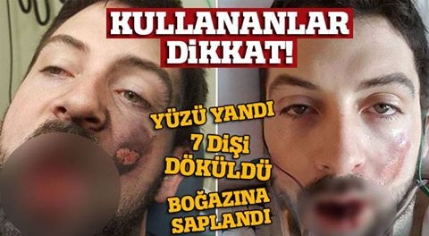 Elektronik sigara yüzünde patladı galerisi resim 1