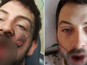 Elektronik sigara yüzünde patladı