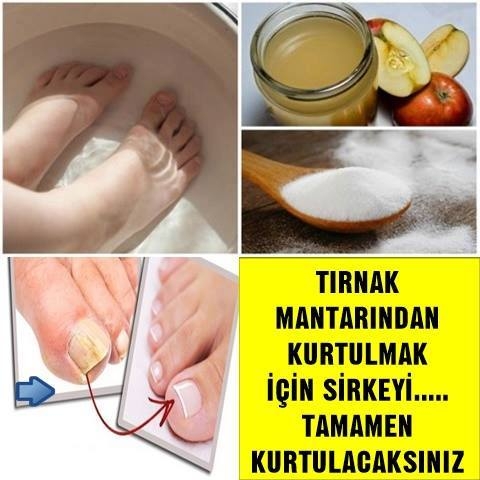 TIRNAK MANTARINDAN KURTULMAK İÇİN SİRKEYİ….. TAMAMEN KURTULACAKSINIZ galerisi resim 1