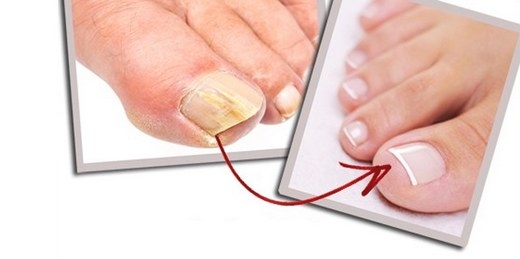 TIRNAK MANTARINDAN KURTULMAK İÇİN SİRKEYİ….. TAMAMEN KURTULACAKSINIZ galerisi resim 4