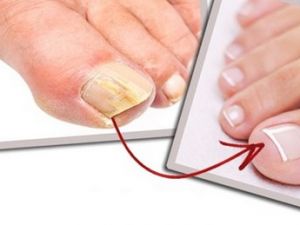 TIRNAK MANTARINDAN KURTULMAK İÇİN SİRKEYİ….. TAMAMEN KURTULACAKSINIZ