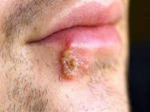 DURMADAN UÇUĞU ÇIKIYORDU BU YÖNTEMLE BAKIN UÇUKLARINDAN NASIL KURTULDU..