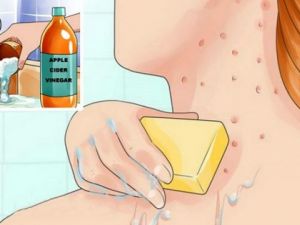 YÜZÜNÜZE, VÜCUDUNUZA ELMA SİRKELİ KARIŞIMDAN SÜRÜN… TÜM SORUNLARIN NASIL