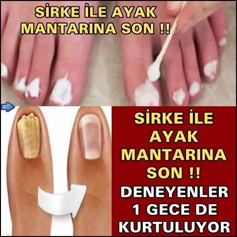 SİRKE İLE AYAK MANTARINA SON !! DENEYENLER 1 GECE DE KURTULUYOR galerisi resim 1