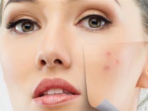 CİLT LEKELERİ MEĞER ÇOK KADAR KOLAY TEDAVİ OLUYORMUŞ BAKIN NASIL