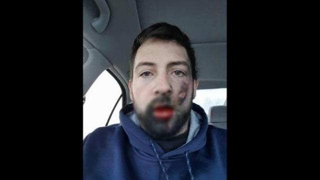 ELEKTRONİK SİGARA YÜZÜNDE PATLADI !!! galerisi resim 2