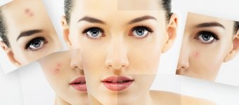 Cilt Lekelerini Hiç Olmamış Gibi Yok Edecek Reçete… Hemen Deneyin.. galerisi resim 4