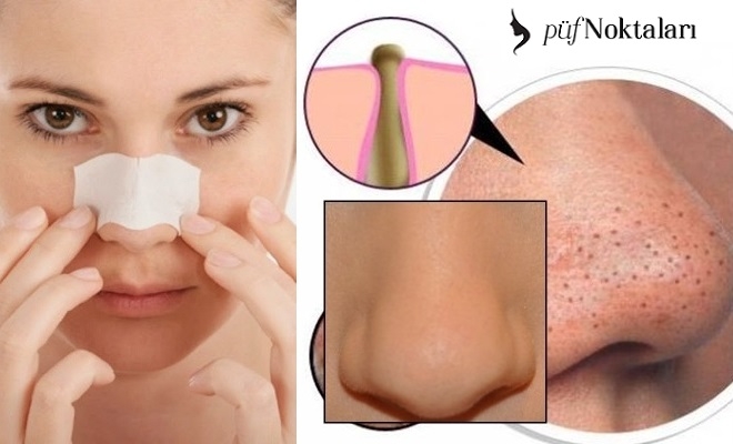 20 dakikada siyah noktaları yok eden karışım!!! galerisi resim 6