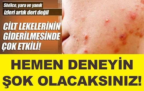 Sivilce, yara ve yanık izleri artık dert değil...! galerisi resim 1