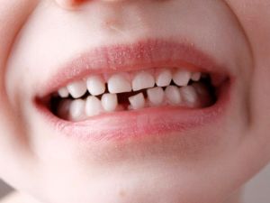Tıp dünyasından gelen bildiri: Çocuklarınızın süt dişlerini atmayın!