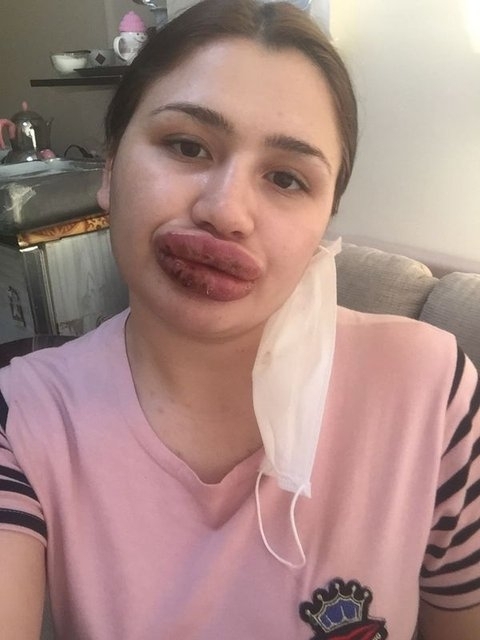 Silikon mağduru hemşirenin son hali ! galerisi resim 4