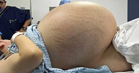 Hamile olduğunu düşünüyordu, doktora gittiğinde büyük şok yaşadı! galerisi resim 1