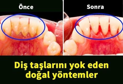 Diş taşlarınızı evde hazırlayacağınız doğal karışımlarla yok etmek artık galerisi resim 1