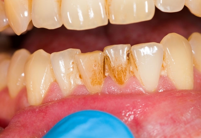 Diş taşlarınızı evde hazırlayacağınız doğal karışımlarla yok etmek artık galerisi resim 2