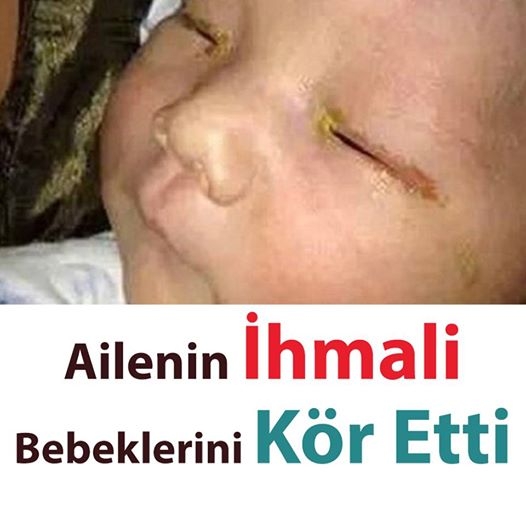 Ailenin İhmali Bebeklerini Kör Etti galerisi resim 1