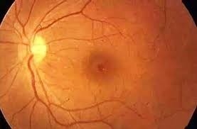 Ailenin İhmali Bebeklerini Kör Etti galerisi resim 3