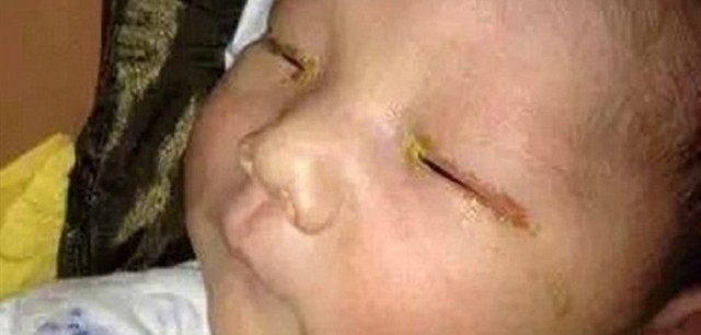 Ailenin İhmali Bebeklerini Kör Etti galerisi resim 5