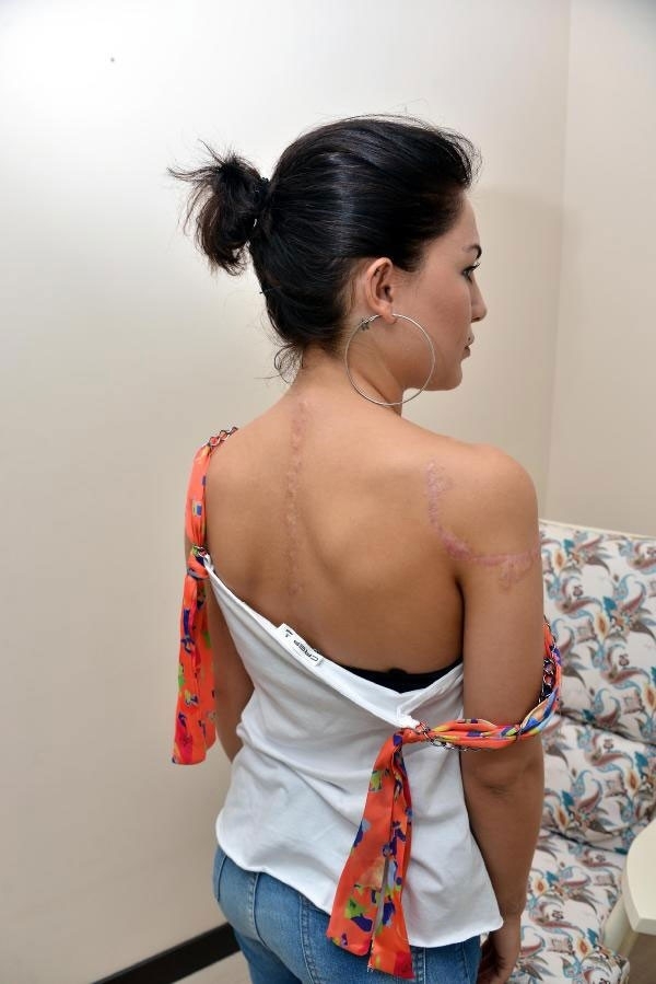 Şu hale bakın! Dövmelerinden kurtulmak istedi hayatı karardı galerisi resim 6