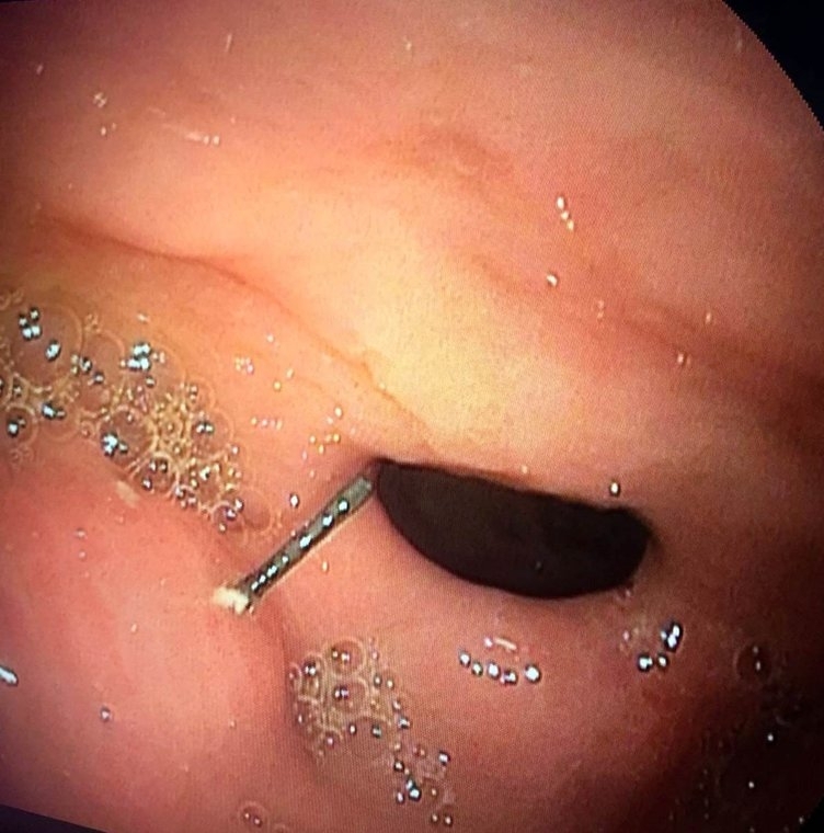 Petek bal yiyen kadının midesinden çıktı! galerisi resim 5