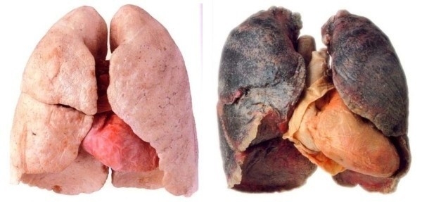 Sigara İçenler Bu Haber Sizin İçin! İşte Akciğerleri Temizlemenin Kolay galerisi resim 2