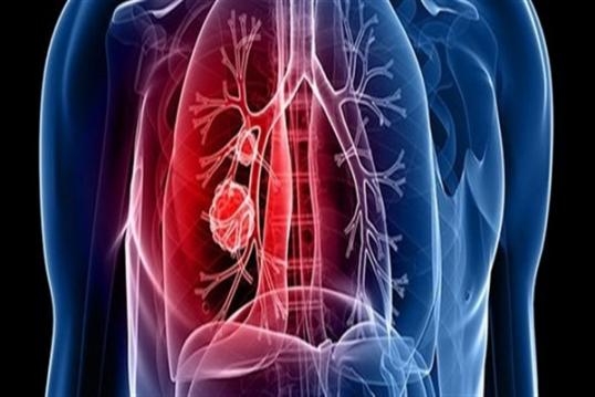 İŞTE AKCİĞER TEMİZLEME KÜRÜ galerisi resim 3